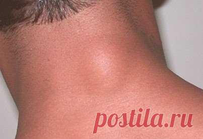 Эффективное средство от жировиков.
Для лечения вам понадобится хозяйственное мыло, вьетнамская звездочка, кусочек полиэтиленового пакета и лейкопластырь.
После душа перед сном густо намазываете жировик и немного вокруг него звездочкой, далее тонким слоем наносите хозяйственное мыло, заклеиваете кусочком полиэтилена и закрепляете пластырем. Наутро жировик прорвет и на этом месте уже не появится