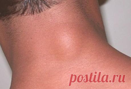 Эффективное средство от жировиков.
Для лечения вам понадобится хозяйственное мыло, вьетнамская звездочка, кусочек полиэтиленового пакета и лейкопластырь.
После душа перед сном густо намазываете жировик и немного вокруг него звездочкой, далее тонким слоем наносите хозяйственное мыло, заклеиваете кусочком полиэтилена и закрепляете пластырем. Наутро жировик прорвет и на этом месте уже не появится