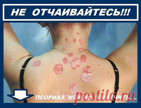 Девчонки.я вечно ходила с закрытой спиной.Теперь могу покрасоваться в открытых нарядах.Я снова счастлива.У меня чистая и гладкая кожа.Мне помогло и вам поможет. Подробнее   ─►