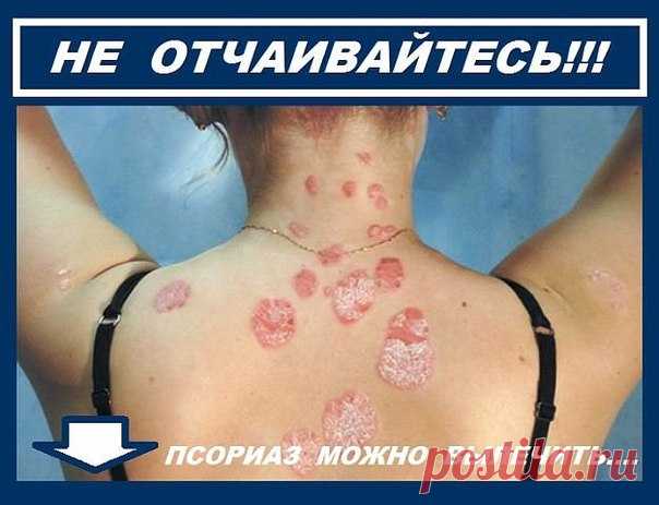 Девчонки.я вечно ходила с закрытой спиной.Теперь могу покрасоваться в открытых нарядах.Я снова счастлива.У меня чистая и гладкая кожа.Мне помогло и вам поможет. Подробнее   ─►