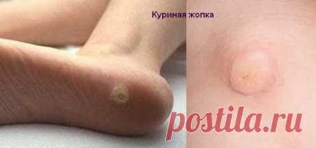 Как избавиться от куриной бородавки на стопе