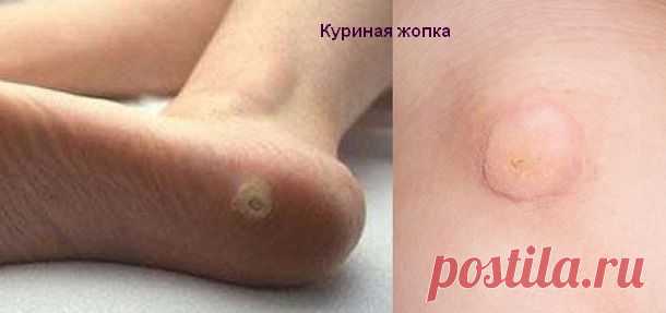 Как избавиться от куриной бородавки на стопе