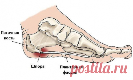 Пяточная шпора: 17 эффективных рецептов народной медицины
