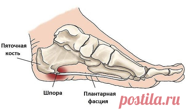 Пяточная шпора: 17 эффективных рецептов народной медицины