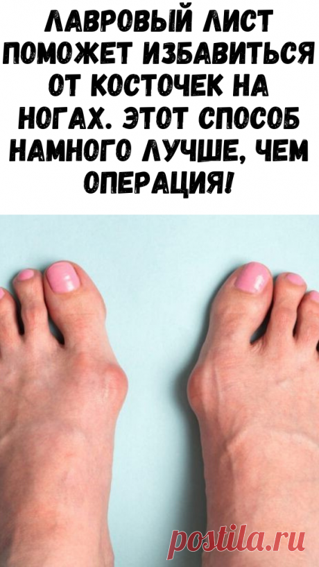 Лавровый лист поможет избавиться от косточек на ногах. Этот способ намного лучше, чем операция!