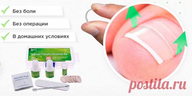 Вросшие ногти – явление, когда пластина растет не только в длину, но и в ширину. Из-за этого у человека появляются сильные боли, он не может нормально ходить. Боковые валики отекают и воспаляются, из-за чего дотронутся до них становится невозможным. Осложняется все тем, что без удаления части пластины избавиться от боли никак не получится. Если у человека есть склонность к врастанию ногтя, то избавиться от проблемы помогут только радикальные меры. Помочь забыть о боли обещает комплекс