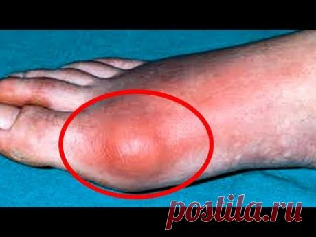 Вот это да! Эффективный метод Н.Н. Штаба ИЗБАВИТ от Болезненной ШИШКИ на НОГЕ..!