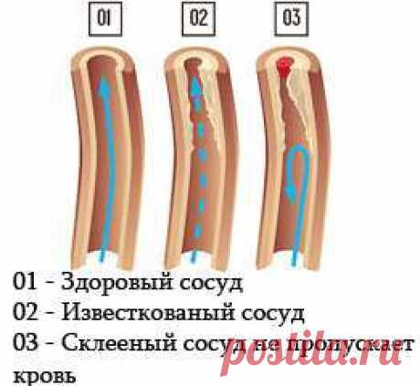 &gt;&gt; Сосуды - очищение сосудов