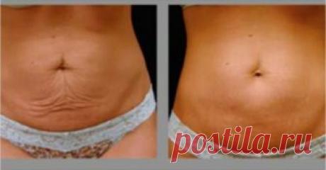 20 способов возвращения упругости кожи после похудения   
            Вы только что потеряли много веса. Может быть, это было вызвано беременностью или вам просто нужно было избавиться от лишних килограмм. В любой ситуации пришло время подумать о том, что…