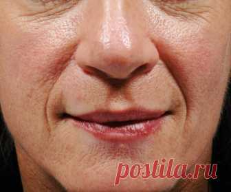 Как заполнить морщины не хуже ботокса. Рецепт замечательной маски | 50+ | Яндекс Дзен