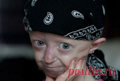 Загадочная история Хейли Окинс: 17-летняя девушка в теле 104-летней старухи