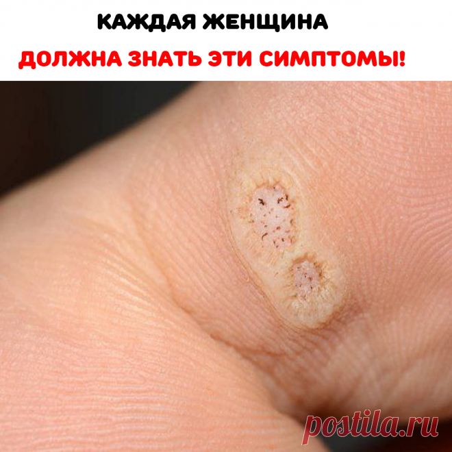 «Презервативы дают всего 60% защиту от ВПЧ, таким образом, вирус может распространяться через кожу, при её контакте с зараженными участками кожи, не покрытой презервативом», —  доктор Мюго.
К сожалению, визуально трудно определить, имеет ли ваш партнер вирус ВПЧ, если у него есть бородавки, но те, кто не имеют видимых признаков также могут распространять этот вирус.
СИМПТОМЫ: наличие  образований в виде папул, папиллом, пятен на кожных покровах и слизистых оболочек+зуд и высыпания у уретры.