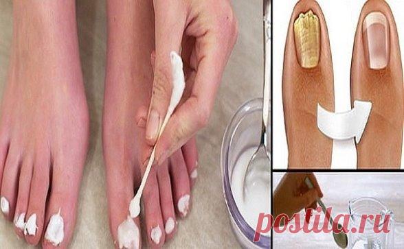 Нанесите это средство на ногти, и через 15 минут о грибке можно будет забыть!
Средство из 3 компонентов избавит от такой ужасной проблемы, как грибок ногтей. Все знают, что это заболевание сопровождается неприятным запахом, исходящим от ног.
Также чешется и зудит кожа, может даже облезать, разрушается ногтевая пластина… Но, применяя это средство от грибка на ногах 2 раза в день, вы полностью вылечите заболевание даже без аптечных препаратов!
средство против грибка ногтей н...