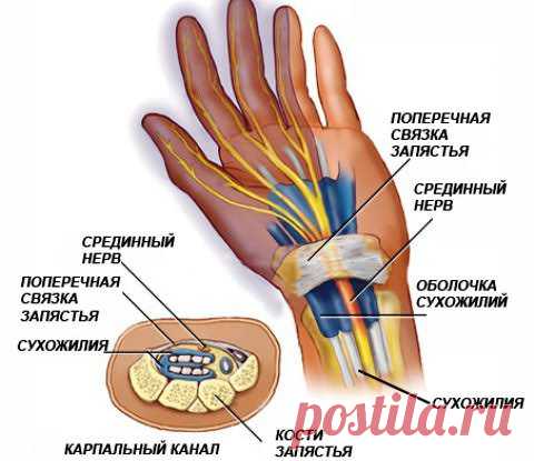 Гимнастика для рук при туннельном синдроме запястья