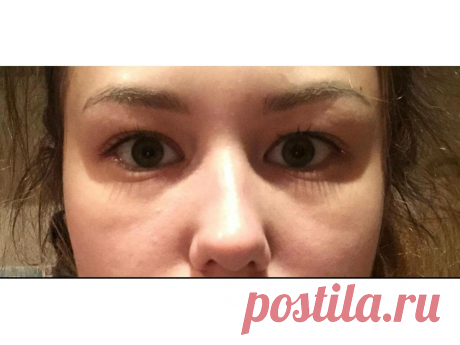 Отек лица у женщин — в чем могут быть причины?
Опухшее лицо не только неэстетично, но и может быть признаком определенных заболеваний. Рассмотрим две причины возникновения такой проблемы. 1. Ангионевротический отек Ангионевротический отек — это сильная припухлость под кожей. Это особенно заметно на лице и конечностях. Наряду с отеком могут появиться и высыпания. К другим характерным симптомам этого состояния относятся отек глаз или век, а […]
Читай дальше на сайте. Жми подробнее ➡