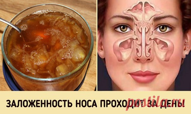 Супер-средство от заложенного носа. Будете свободно дышать уже на утро! Даже если у вас отличный иммунитет, от этого недуга никто не застрахован. Особенно, если вы много работаете с людьми и ездите в общественном транспорте. У