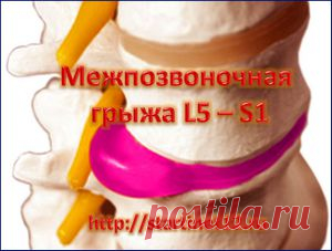 Как без операций вылечить межпозвоночную грыжу L5 – S1? | Здоровье без лекарств