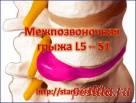 Как без операций вылечить межпозвоночную грыжу L5 – S1? | Здоровье без лекарств