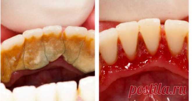 Способ избавления от зубного камня прямо у себя дома  Мы все ненавидим зубной камень. И все ненавидим бывать у стоматолога.

Вот вам простой рецепт, который поможет сохранить зубы и легко справиться с такой проблемой, как зубной камень.

Если не следить…
