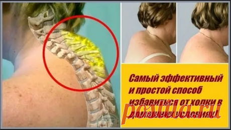 Как быстро убрать горб со спины