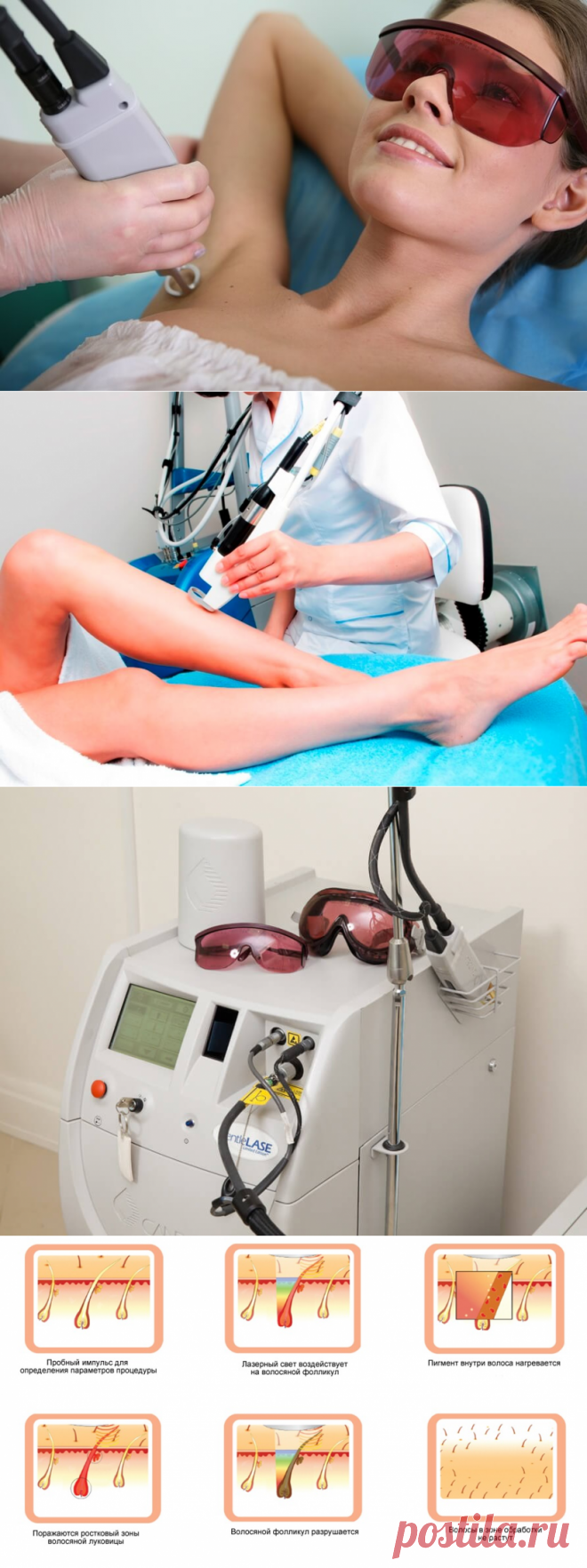 Александритовый лазер для эпиляции: отзывы и рекомендации