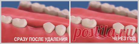 В какой срок после удаления зуба можно установить имплантат? | записки зубного детектива | Яндекс Дзен