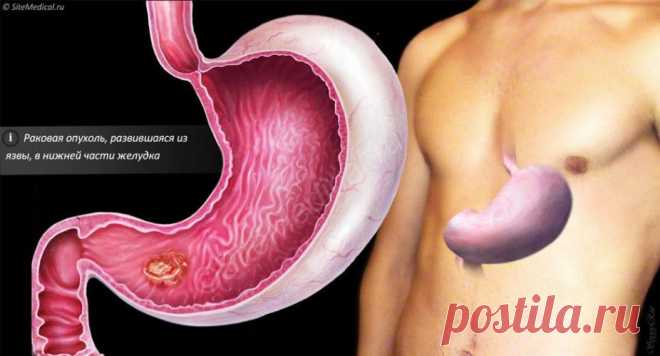 Гастрит желудка. Симптомы и лечение гастрита народными средствами
Ритм жизни современного человека, с его частыми стрессами, далеко не самым сбалансированным питанием, употреблением некачественных продуктов и т.д. нередко приводит к проблемам пищеварительной системы. Наиболее частой заслуженно считается гастрит — воспаление слизистой оболочки желудка.