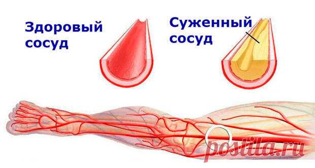 Чистые сосуды: 5 золотых рецептов от травника. Лечение атеросклероза - медиаплатформа МирТесен Многие люди с возрастом начинают испытывать неприятное ощущение, когда по ночам немеют пальцы рук и ног. Зачастую эти признаки свидетельствуют о развитии атеросклероза кровеносных сосудов. Атеросклероз — это одно из самых серьезных сердечных заболеваний, когда стенки сосудов уплотняются, а в местах
