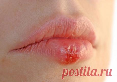 7 народных методов избавления от герпеса