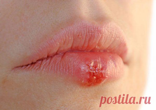 7 народных методов избавления от герпеса