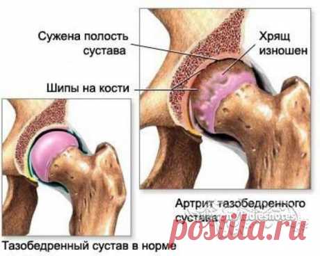 НАСТУПИТ СРОК, УЙДЁТ АРТРИТ И БОЛЬШЕ ВАС НЕ ПОСЕТИТ | Женский журнал