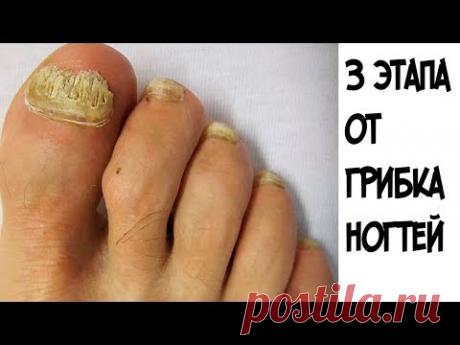 Эти 3 ЭТАПА помогут избавиться от грибка ногтей НАВСЕГДА
