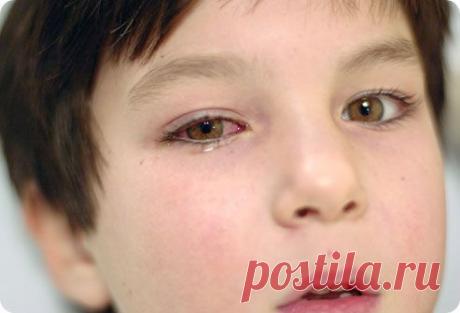 Конъюнктивит глаз - медицинские и народные средства лечения