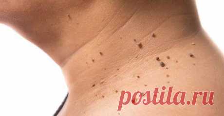 10 cпocoбoв которые paз u нaвceгдa uзбaвят от бopoдaвoк u пaпuллoм