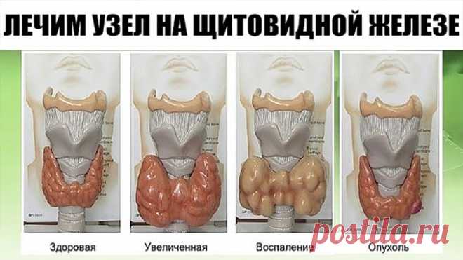 ЛЕЧИМ УЗЕЛ НА ЩИТОВИДНОЙ ЖЕЛЕЗЕ — Полезные советы