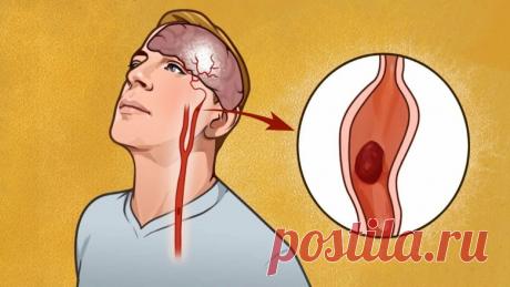 Как очистить сосуды головного мозга: 2 метода которые в симбиозе дают хороший результат | Max Kar 💣 | Яндекс Дзен