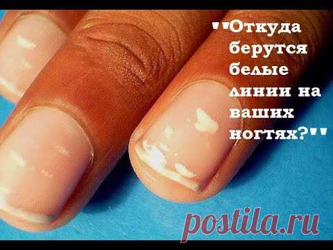 Белые пятна на ногтях рук как следствие нарушений в организме