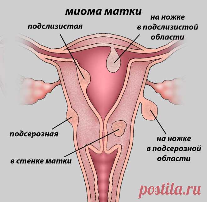Миома матки: 5 вещей, которые нужно знать
Лечение меняется в зависимости от размера миомы. Иногда для их удаления требуется хирургическое вмешательство, а в других случаях достаточно правильного медикаментозного лечения и регулярных осмотров.   Испанское общество гинекологии и акушерства (SEGO) заявляет, что у 70% женщин может развиться миома матки. Первое, что нужно знать, это то, что только 0,5% этих миом могут перейти в […]
Читай пост далее на сайте. Жми ⏫ссылку выше