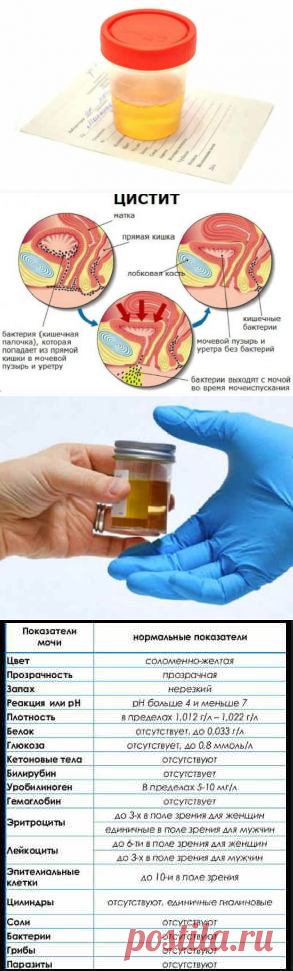 Анализ мочи при цистите, расшифровка, показатели