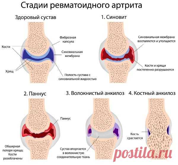 КАРТОФЕЛЬ НА КЕФИРЕ ПРОТИВ АРТРИТА