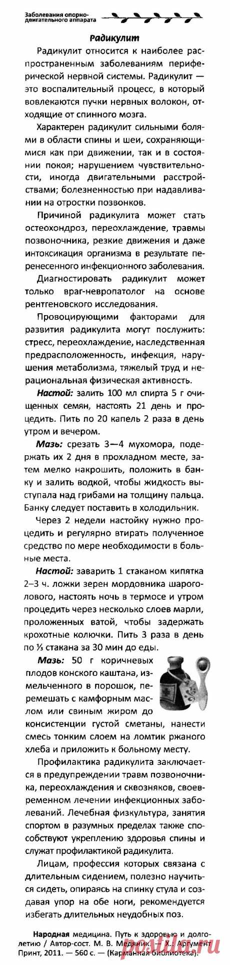 Радикулит