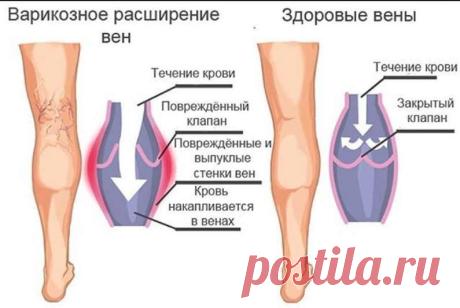 Тромбоз и варикоз можно вылечить народными способами. Мудрость предков на страже здоровья!