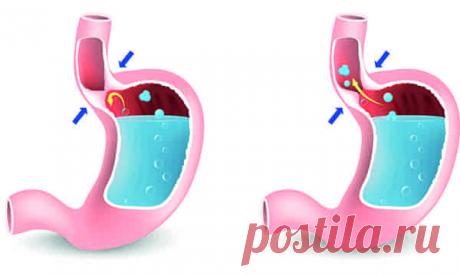 Рефлюкс-эзофагит  (код МКБ-10; код МКБ-11): описание, причины, симптомы, как лечить  | Клиника лечения боли: врачи онлайн