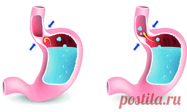 Рефлюкс-эзофагит  (код МКБ-10; код МКБ-11): описание, причины, симптомы, как лечить  | Клиника лечения боли: врачи онлайн