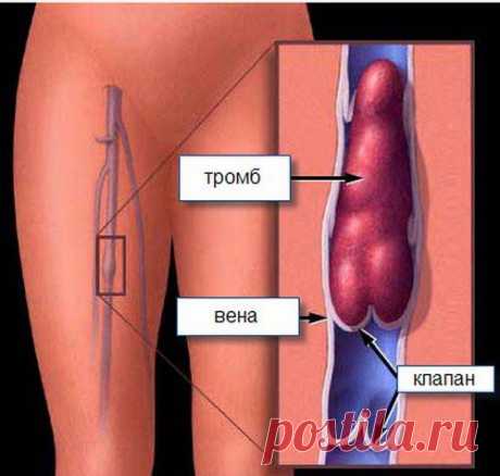 Рецепты от гипертонии и тромбофлебита | Друг пенсионера