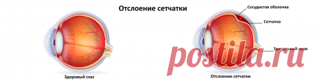 Отслойка сетчатки: признаки и способы лечения. | VISTA центр инновационной офтальмологии | Дзен