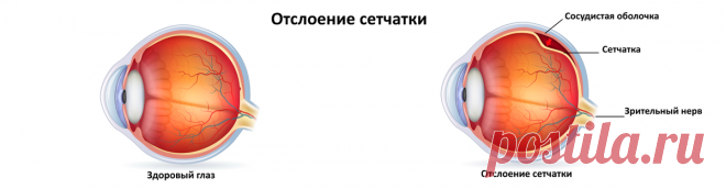 Отслойка сетчатки: признаки и способы лечения. | VISTA центр инновационной офтальмологии | Дзен