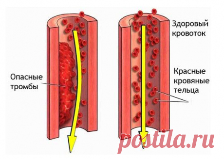 Профилактика образования тромбов.