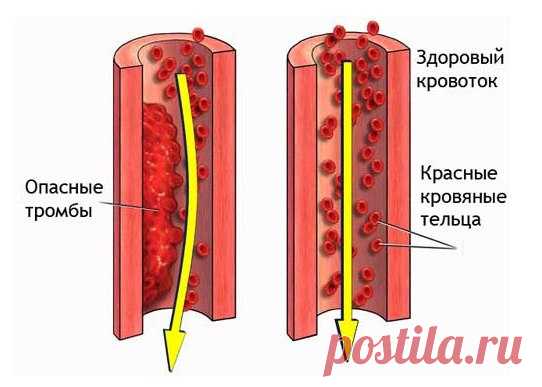 Профилактика образования тромбов.
