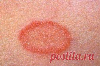 Цветной лишай. Причины, лечение цветного лишая в домашних условиях 
Цветной лишай – это грибковое заболевание, характеризующееся появлением на коже пятен разного цвета. Болезнь поражает людей, склонных к дерматомикозам, причем заражение чаще всего происходит в жаркое…